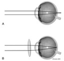 Figure 6 of 3rd Edition - Understanding and Managing Visual Deficits